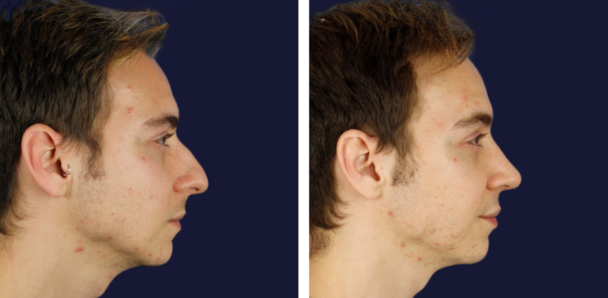 rinoplastia-hombre-20