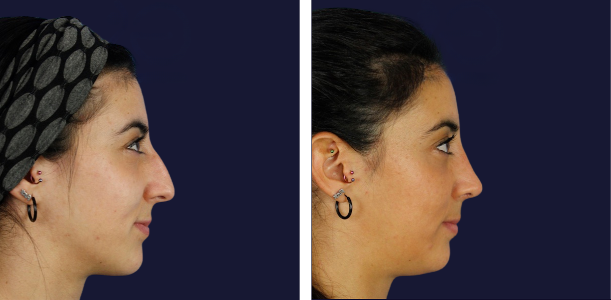 rinoplastia-mujer-25