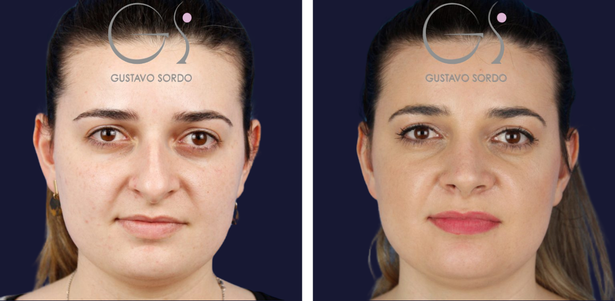 rinoplastia-para-rebajar-caballete-1536x753