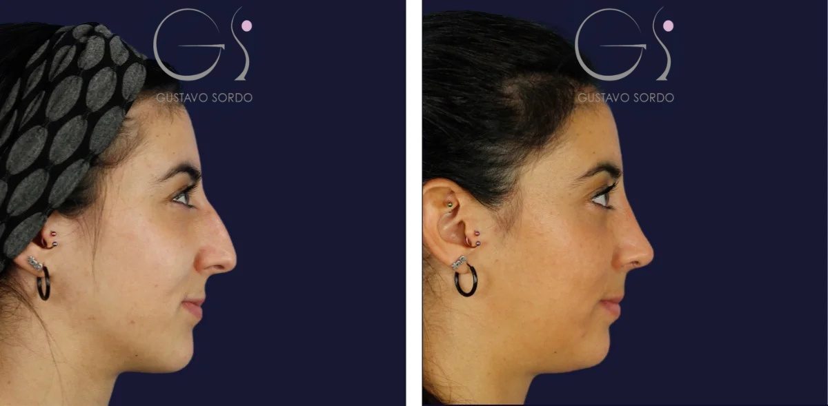 capa para rinoplastia 45677