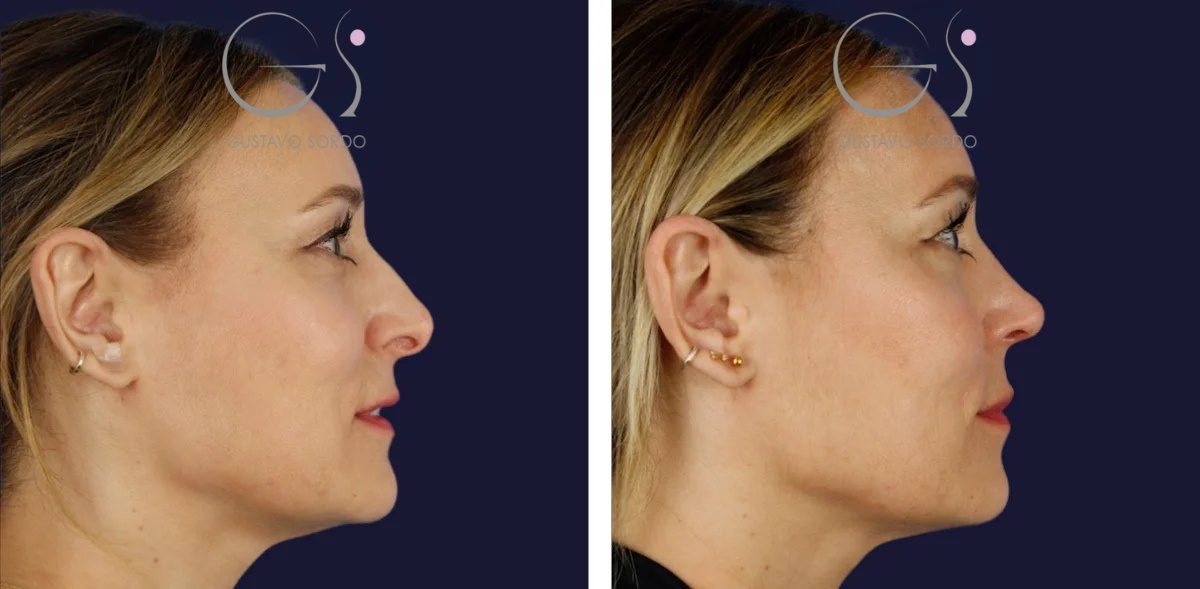 rinoplastia portada 45678