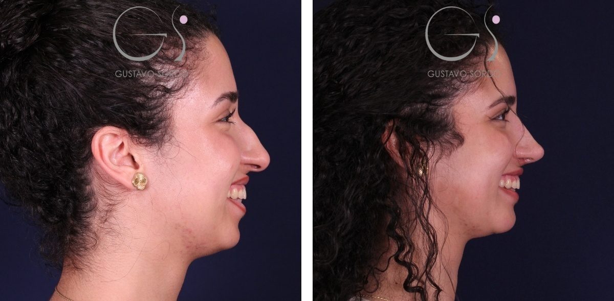 Rhinoplastie de préservation : avant et après