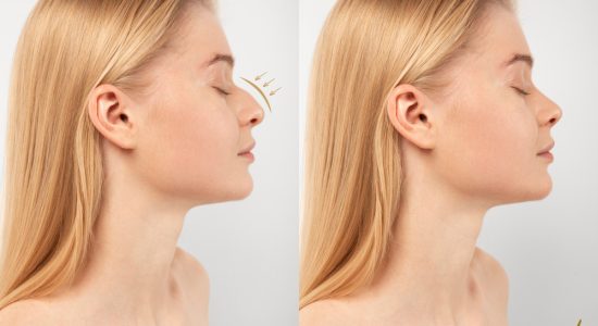 rinoplastia perfil antes y despues