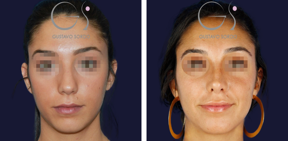 rinoplastia-ultrasonica-mujer-28