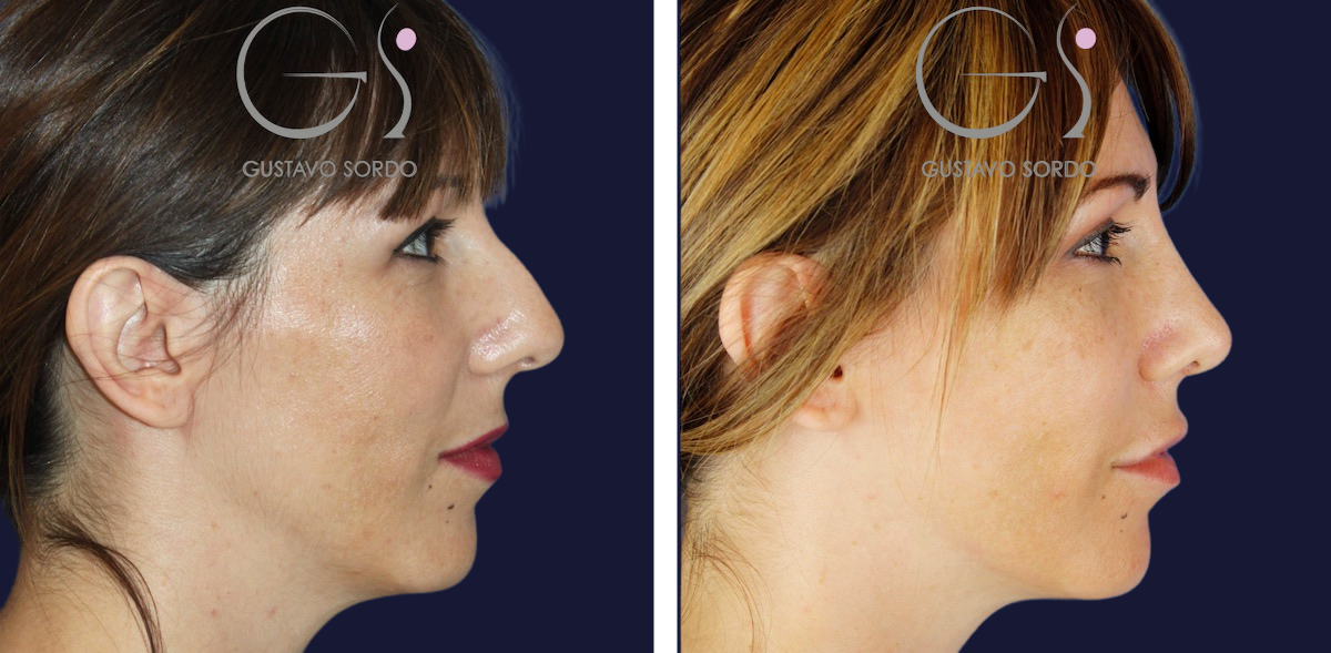 rinoplastia-ultrasonica-mujer-32