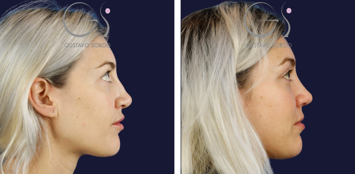 rinoplastia-y-blefaroplastia