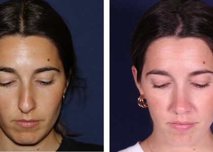 tabique-desviado-annng